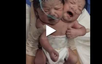 Bebê com duas cabeças nasce em Fernandópolis