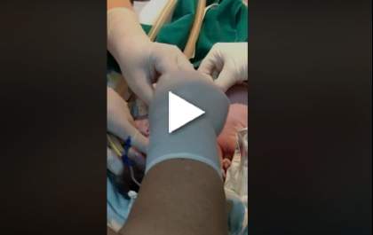 Vídeo do nascimento da menina com duas cabeças é divulgado nas redes sociais