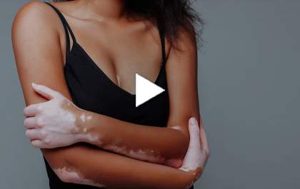 Vitiligo: sintomas e tratamentos com a Dra. Maria Angélica