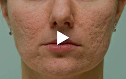 Acne: tudo que você precisa saber