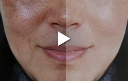 Vamos falar de Melasma?