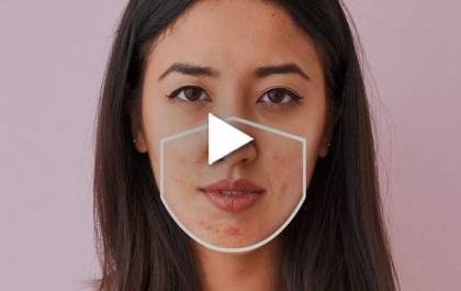 Maskne: Saiba o que é, e como prevenir