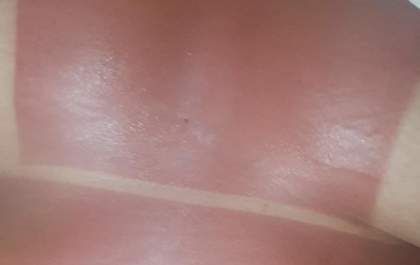 Dermatologista alerta: Bronzeamento natural não é aconselhável