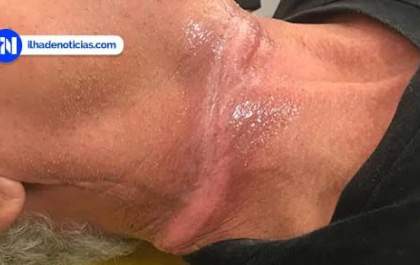 Fio de fibra óptica cai durante instalação e atinge motociclista