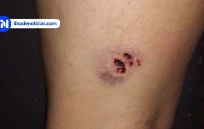 Mulher é mordida na perna em Ilha Solteira