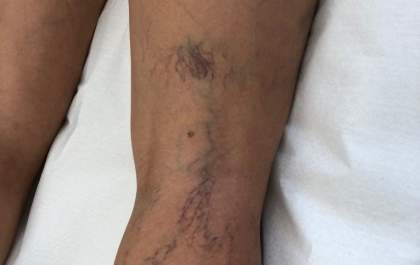 Ao retirar as veias com a cirurgia terei a circulação prejudicada?