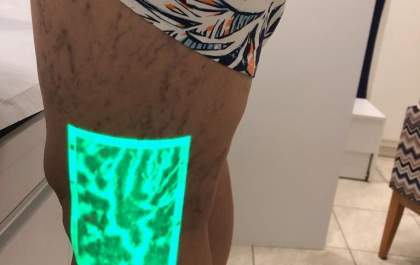 Por que as pernas incham no calor?