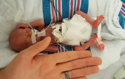 Bebê que nasceu com 310 gramas já está em casa