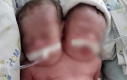 Tristeza sem fim: Gêmeas siamesas morrem após seis dias internadas