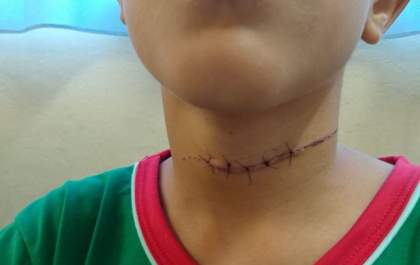 Garoto atingindo por linha chilena teve corte profundo no pescoço