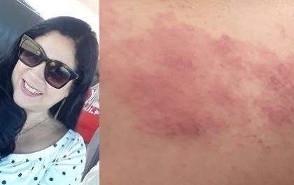 Professora faz alerta sobre Herpes-zóster