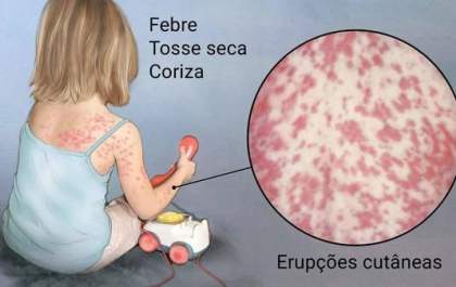 Araçatuba tem sete casos de sarampo confirmados