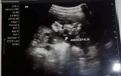 Gestante que descobriu que a bebê só tem a parte da frente do cérebro precisa de ajuda