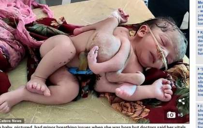 Bebê nasce com três mãos e quatro pernas por causa de má formação no útero