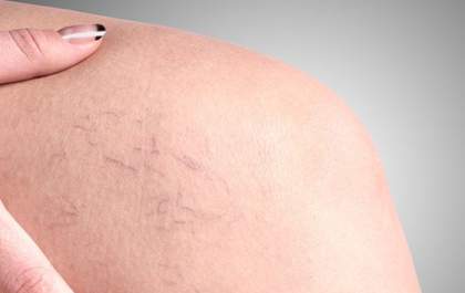 Especialistas esclarecem se as varizes voltam mesmo após o tratamento