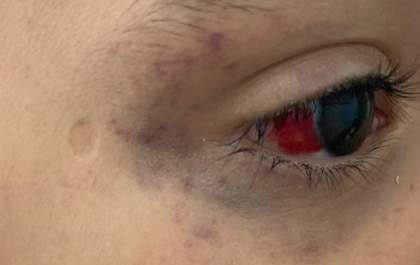 Criança é torturada por 24h com fio de celular pelo padrasto por fazer xixi na cama