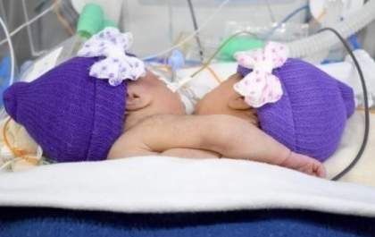 Gêmeas siamesas interligadas pelo tórax morrem no hospital