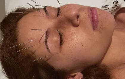 Agulhas nos olhos? Sim, acupuntura também é utilizada para doenças oculares