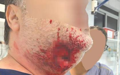 Médico tem lesão grave no pescoço ao ser mordido por paciente