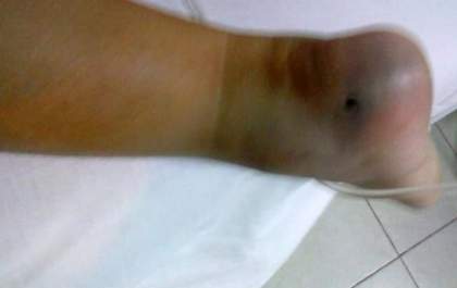 Criança é picada por escorpião em Três Lagoas
