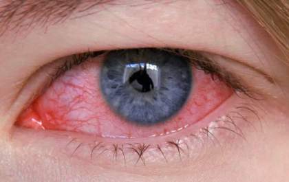 Tracoma ocular: doença altamente contagiosa e uma das principais causas de cegueira no mundo