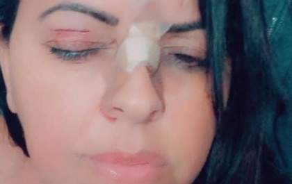 Mulher tem rosto ferido por linha de cerol