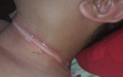 Jovem tem pescoço ferido por fio de telefonia solto em Birigui