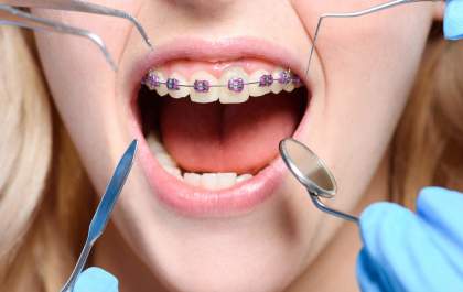 4 indicativos de que você precisa usar aparelho ortodôntico
