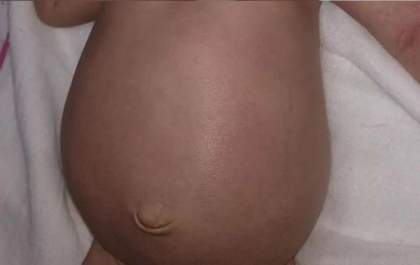 Criança de um mês com doença rara precisa de ajuda para fazer cirurgia