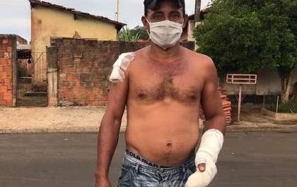 Bebê que teve 70% do corpo queimado foi resgatado de incêndio por vizinho