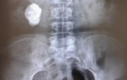 Mulher que ficou com compressa de algodão dentro da barriga após cesariana será indenizada
