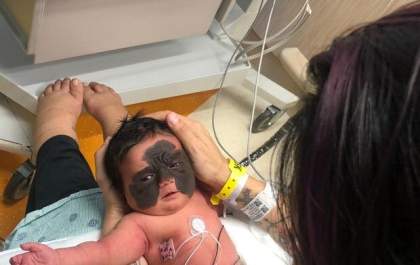 Brasileira de 2 anos com condição rara faz tratamento para remover mancha no rosto