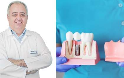 Tire suas dúvidas sobre implantes dentários