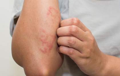 Sofre com alergias mas não sabe a causa? - Conheça o teste IgE específico para detecção