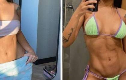 Lipo lad: médico fala sobre mitos e verdades da 'cirurgia do momento'&nbsp;