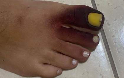 Viralizou: Após calçar tênis com piolho-de-cobra, mulher fica com dedo roxo e unha amarela