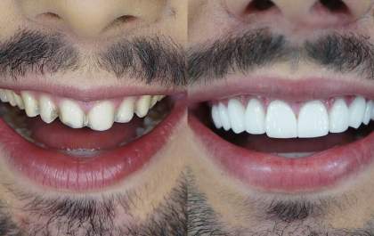 Dr. Rodrigo Peres Urban esclarece 5 dúvidas sobre as lentes de contato dental. Confira!