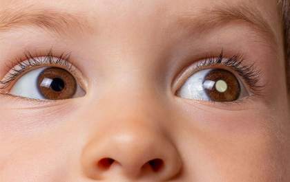 Retinoblastoma: especialista alerta para câncer raro da filha de Tiago Leifert