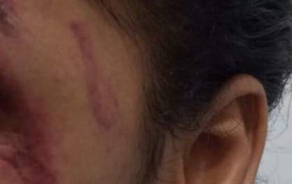 Mulher é agredida pelo marido e sofre lesões nos braços e rosto em Três Lagoas&nbsp;