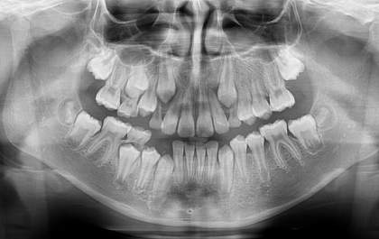 Para que serve a radiografia panorâmica?&nbsp;