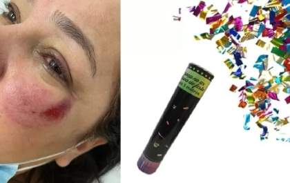 Professora fere olho após lança-confetes estourar em SP e faz alerta