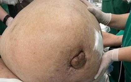 Mulher tem tumor de 46 kg retirado em cirurgia de emergência no RJ
