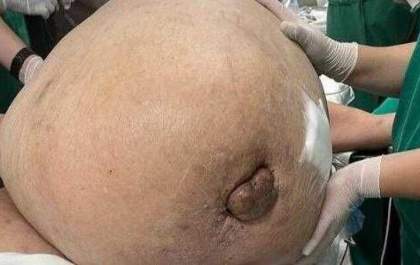 Morre mulher que teve tumor de 46 kg retirado em cirurgia de emergência