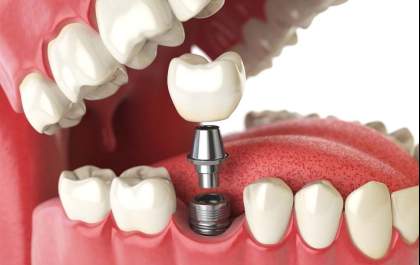 Prótese dentária ou implante, qual escolher? Entenda as diferenças entre os procedimentos com a OdontoX