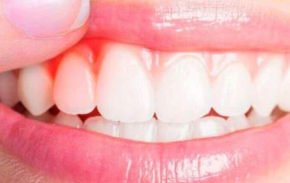 Gengivite: dentista revela o que é e como prevenir doença