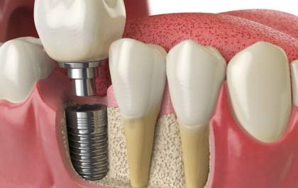 Conheça a cirurgia guiada de implantes, procedimento sem cortes e com maior precisão