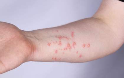 Birigui registra dois casos de monkeypox, um de chikungunya e mais de 9 mil de dengue em 2022