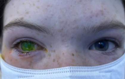Austrália tem aumento do número de casos de doença que causa olhos verdes e dor equivalente à de parto