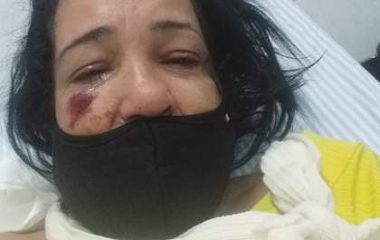 Mulher com fratura no braço após queda de moto se queixa por ter recebido alta de hospital sem cirurgia