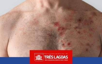 Publicado novo boletim dos casos de MONKEYPOX em Três Lagoas